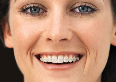 Ceramic Braces For Adults 35