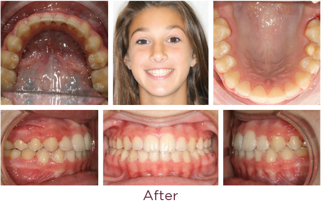 Class 2 orthodontic problem after