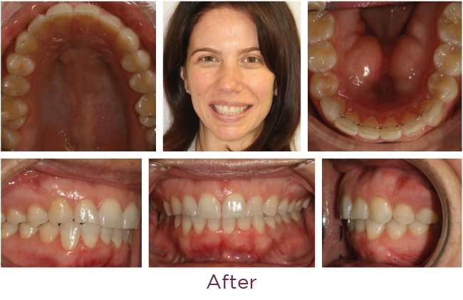 Incognito Lite braces treatment after