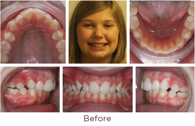 Braces in Bridgewater NJ