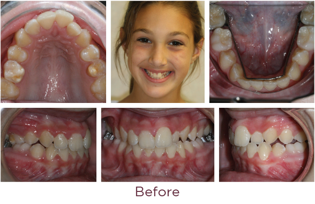 Class 2 orthodontic problem before