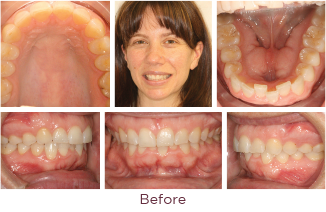 Incognito Lite braces treatment before